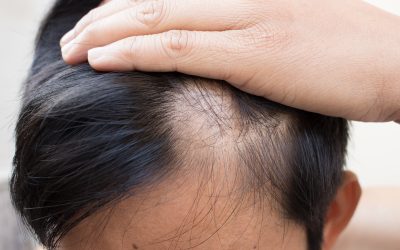 Achieve Smooth Skin Year Round With Laser Hair Removal in Rochester NY Professionals